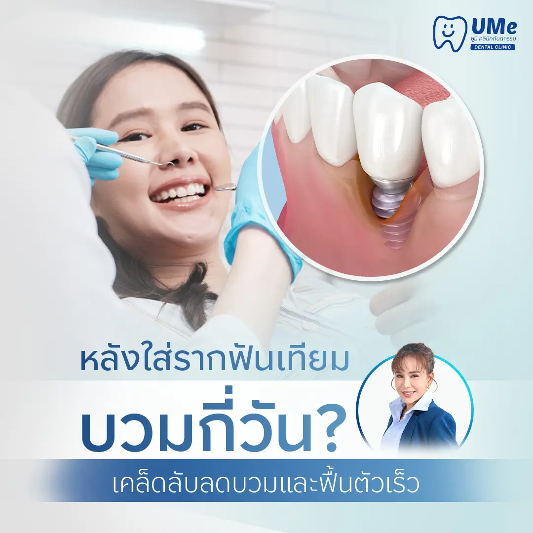 ใส่รากฟันเทียม บวม กี่วัน