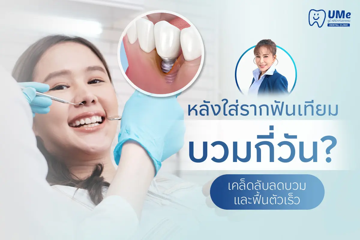 ใส่รากฟันเทียม บวม กี่วัน