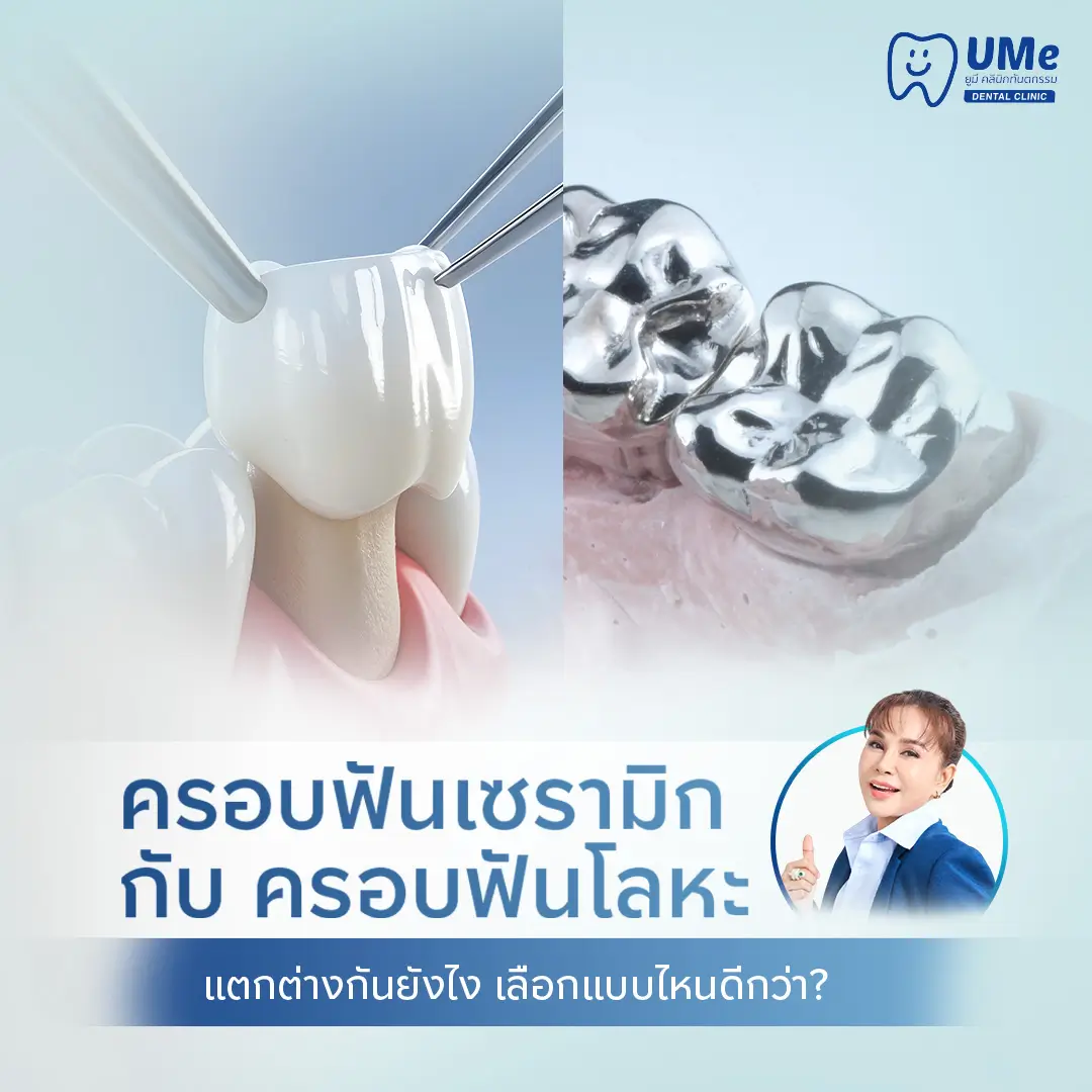 ครอบฟันเซรามิก