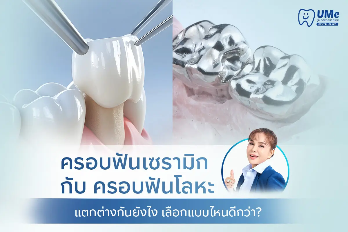 ครอบฟันเซรามิก
