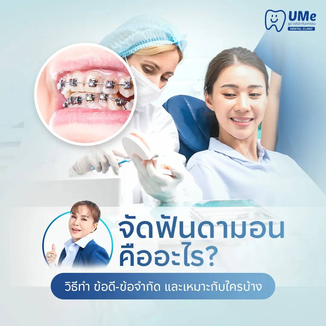จัดฟันดามอน