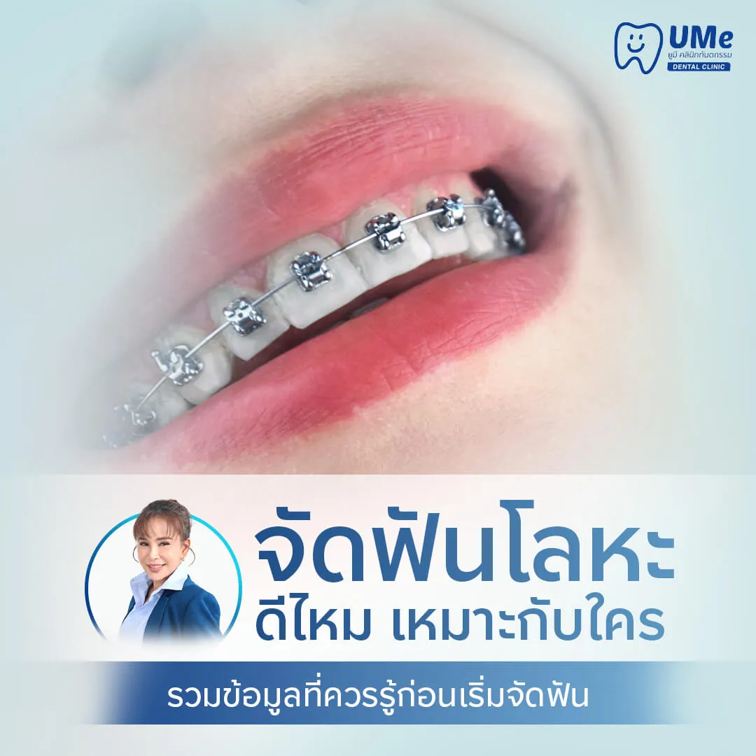 จัดฟันโลหะ