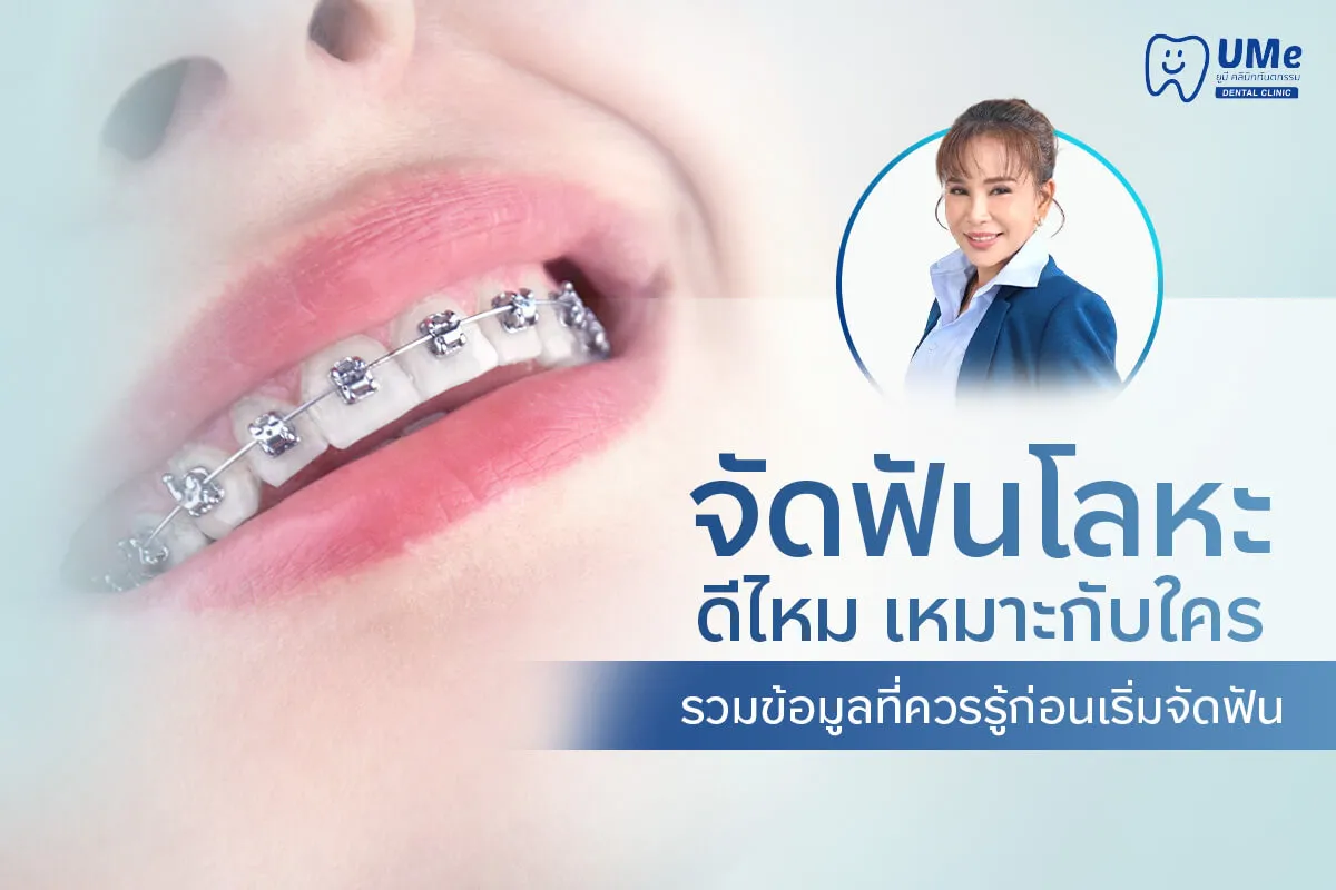 จัดฟันโลหะ