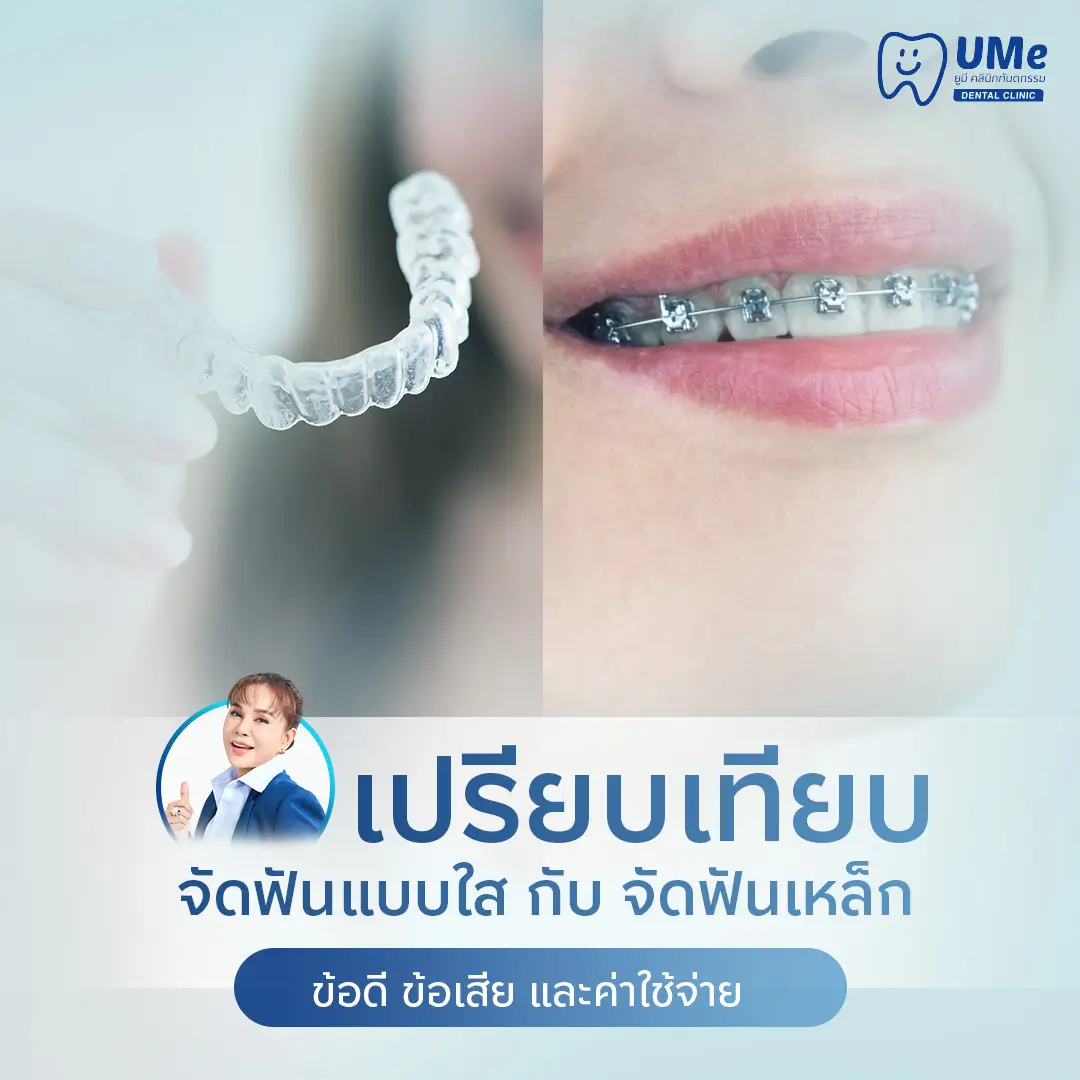 จัดฟันแบบใส กับ แบบเหล็ก แบบไหนดีกว่า