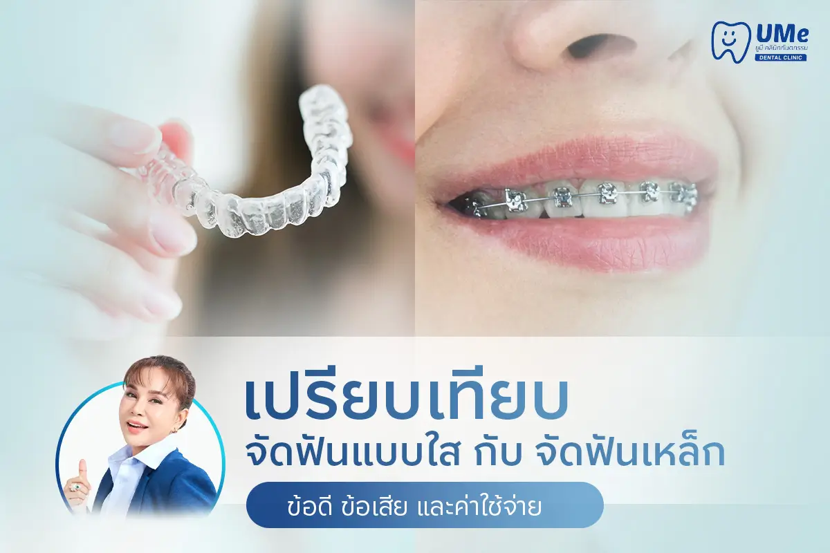 เปรียบเทียบจัดฟันแบบใส กับ จัดฟันเหล็ก ข้อดี ข้อเสีย และค่าใช้จ่าย