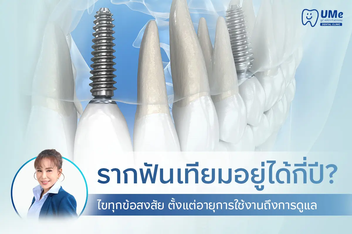 รากฟันเทียมอยู่ได้กี่ปี