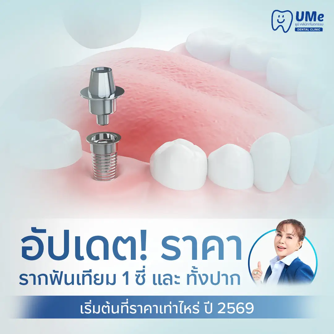 ราคารากฟันเทียม1ซี่