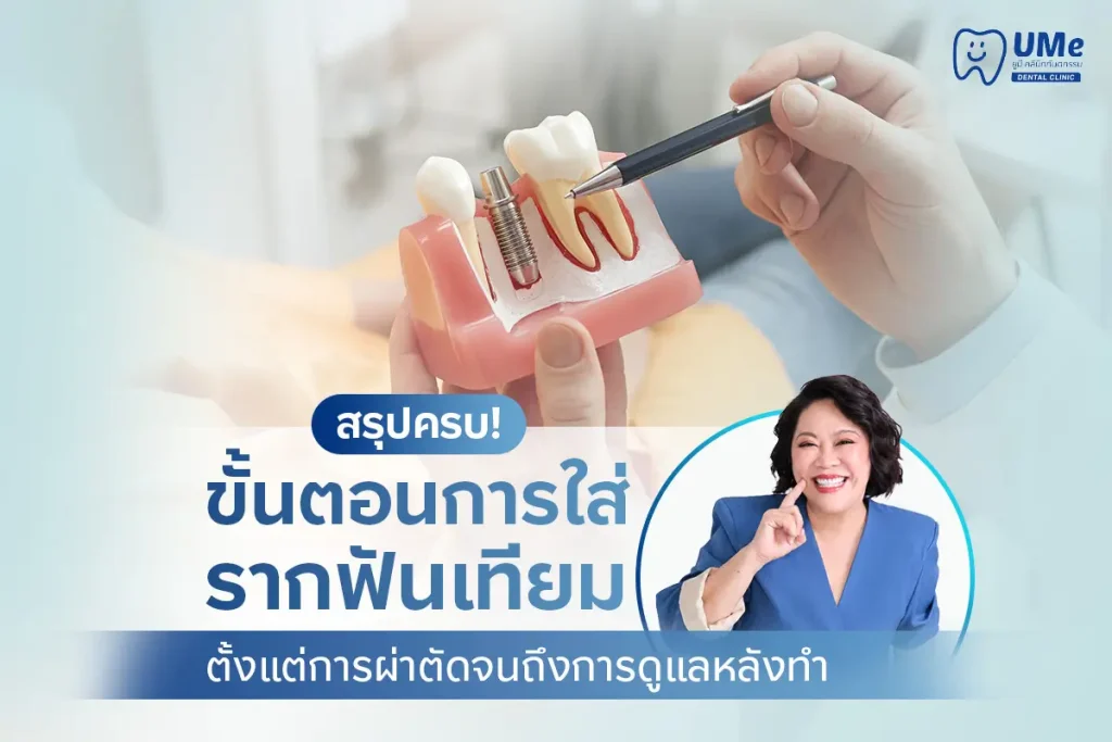ขั้นตอนการใส่รากฟันเทียม