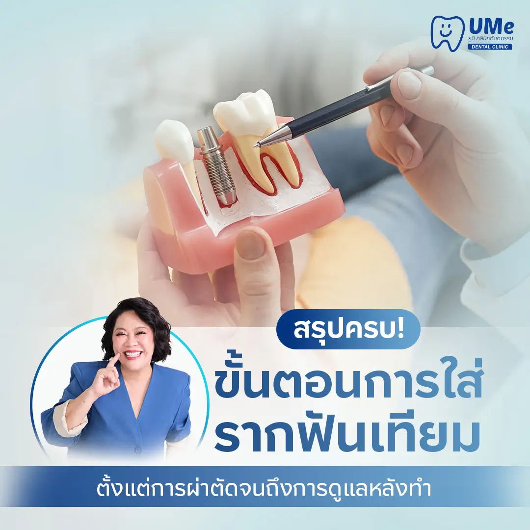 ขั้นตอนการใส่รากฟันเทียม